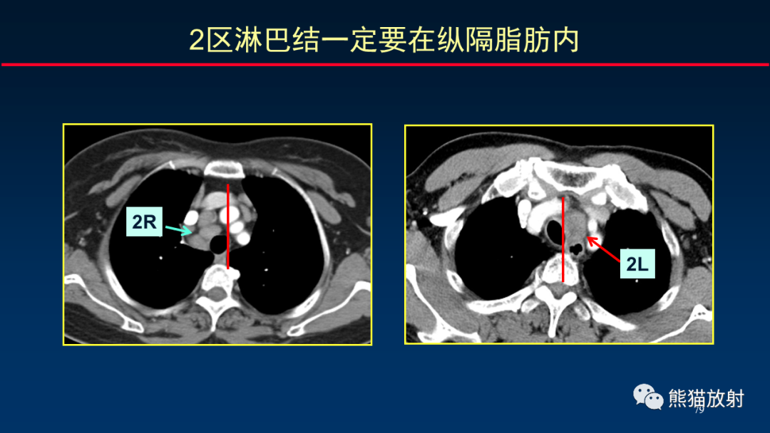 【PPT】纵隔与肺门淋巴结的识别与精准CT分区-79