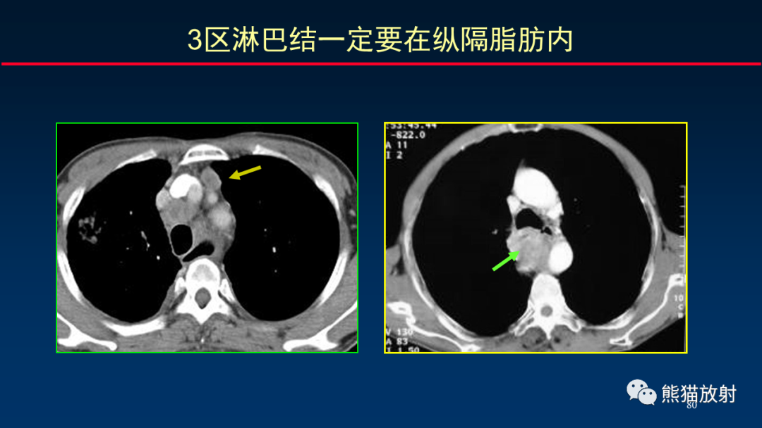 【PPT】纵隔与肺门淋巴结的识别与精准CT分区-80