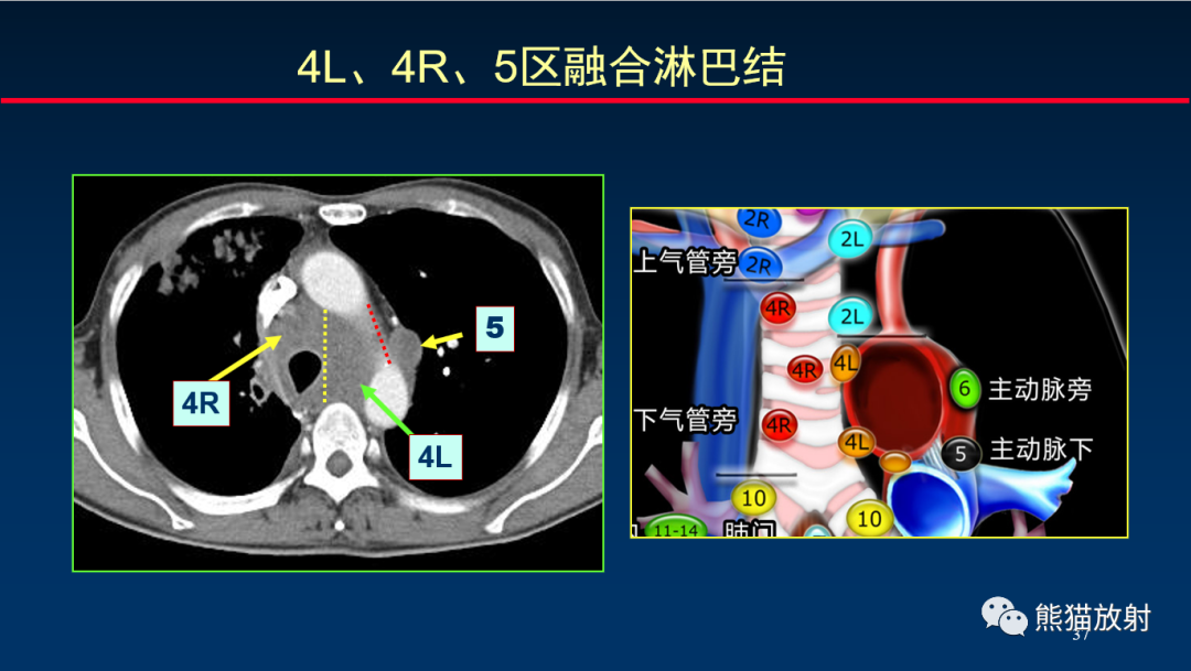【PPT】纵隔与肺门淋巴结的识别与精准CT分区-37