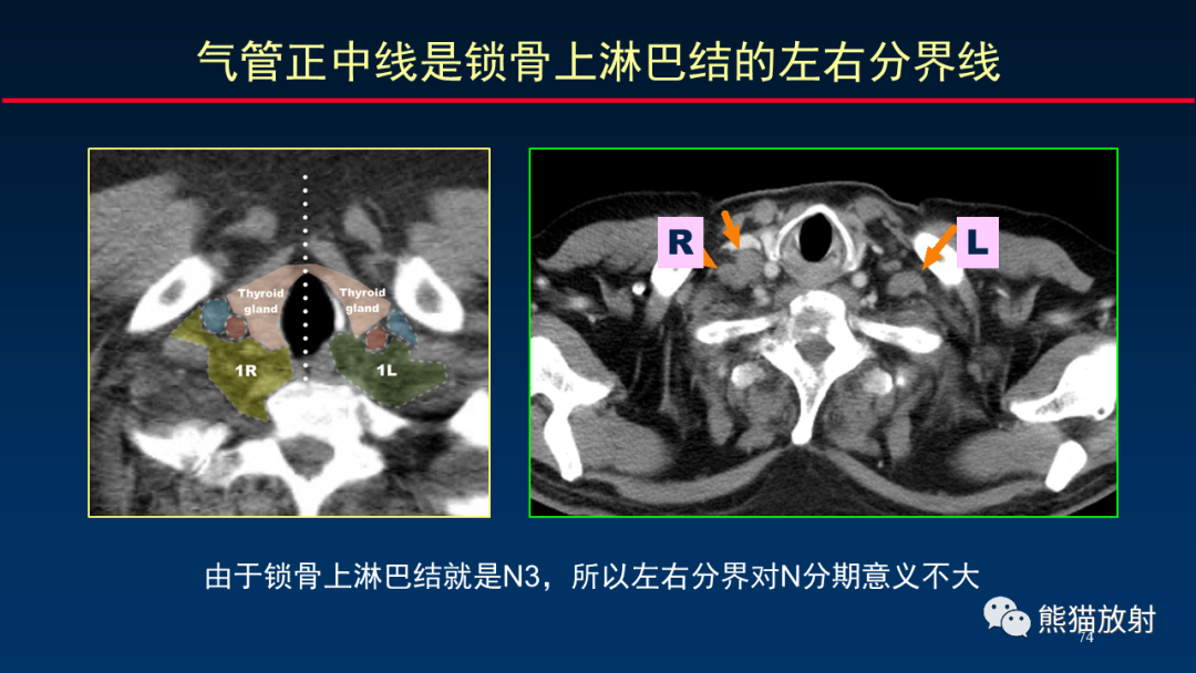 【PPT】纵隔与肺门淋巴结的识别与精准CT分区-74