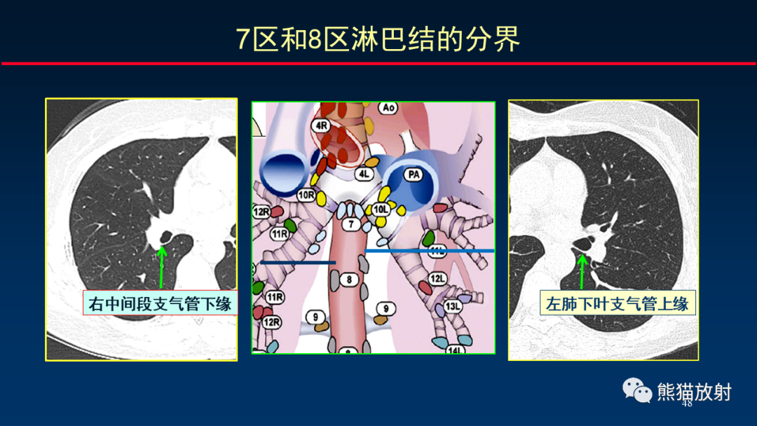 【PPT】纵隔与肺门淋巴结的识别与精准CT分区-48