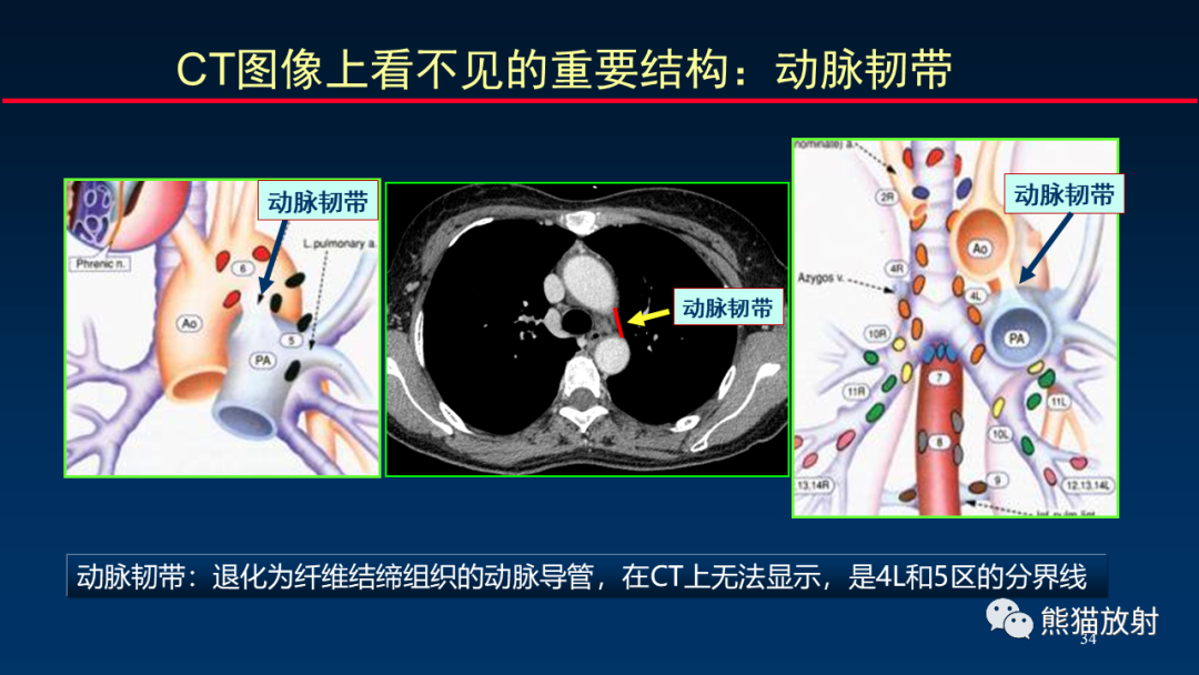 【PPT】纵隔与肺门淋巴结的识别与精准CT分区-34