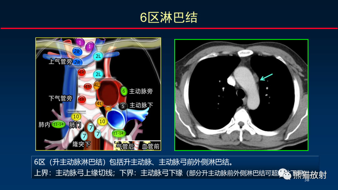 【PPT】纵隔与肺门淋巴结的识别与精准CT分区-38