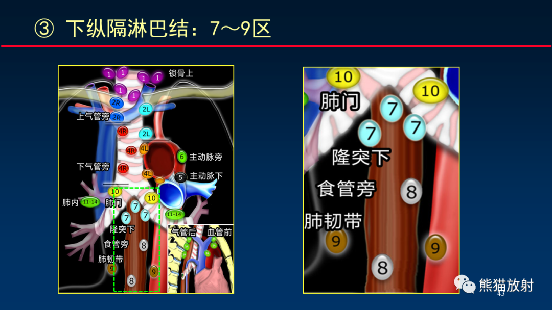【PPT】纵隔与肺门淋巴结的识别与精准CT分区-43