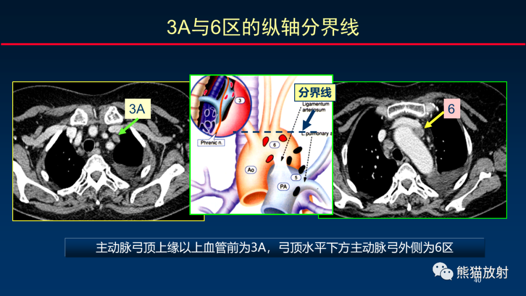 【PPT】纵隔与肺门淋巴结的识别与精准CT分区-40