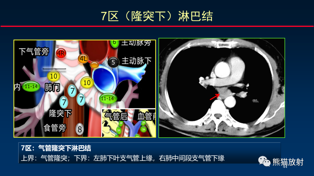 【PPT】纵隔与肺门淋巴结的识别与精准CT分区-44