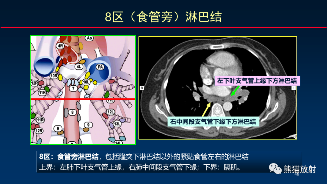 【PPT】纵隔与肺门淋巴结的识别与精准CT分区-46