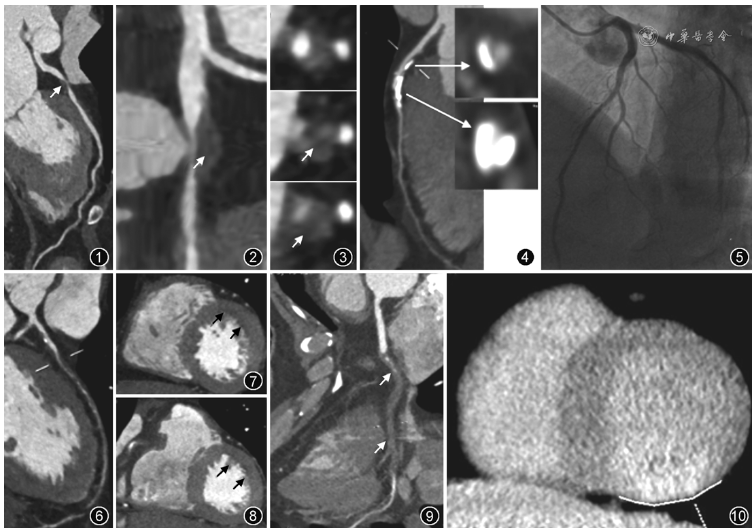 冠状动脉CT血管成像最新临床应用推荐及诊断规范-1