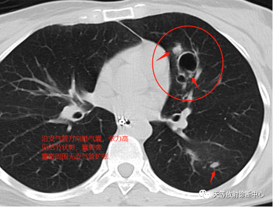 【病例】肺非结核分枝杆菌(NTM-PD)一例CT影像-1 【病例】肺非结核分枝杆菌(NTM-PD)一例CT影像-1