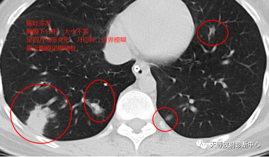 【病例】肺非结核分枝杆菌(NTM-PD)一例CT影像-4 【病例】肺非结核分枝杆菌(NTM-PD)一例CT影像-4