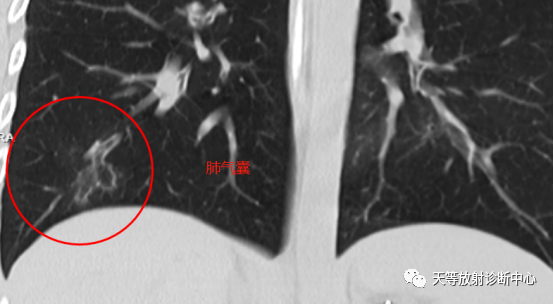 【病例】肺非结核分枝杆菌(NTM-PD)一例CT影像-5 【病例】肺非结核分枝杆菌(NTM-PD)一例CT影像-5