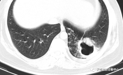 【病例】肺非结核分枝杆菌(NTM-PD)一例CT影像-15 【病例】肺非结核分枝杆菌(NTM-PD)一例CT影像-15
