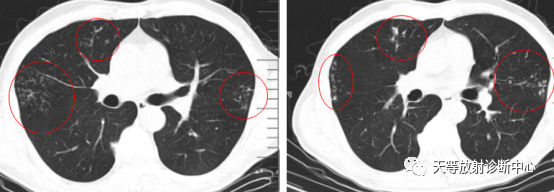 【病例】肺非结核分枝杆菌(NTM-PD)一例CT影像-13 【病例】肺非结核分枝杆菌(NTM-PD)一例CT影像-13