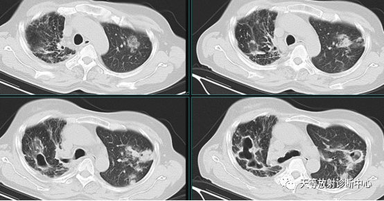 【病例】肺非结核分枝杆菌(NTM-PD)一例CT影像-14 【病例】肺非结核分枝杆菌(NTM-PD)一例CT影像-14