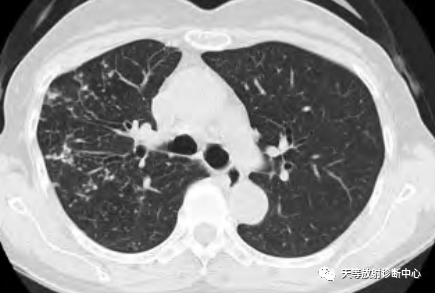 【病例】肺非结核分枝杆菌(NTM-PD)一例CT影像-10 【病例】肺非结核分枝杆菌(NTM-PD)一例CT影像-10