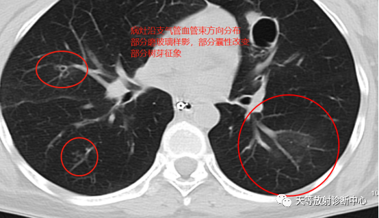 【病例】肺非结核分枝杆菌(NTM-PD)一例CT影像-2 【病例】肺非结核分枝杆菌(NTM-PD)一例CT影像-2