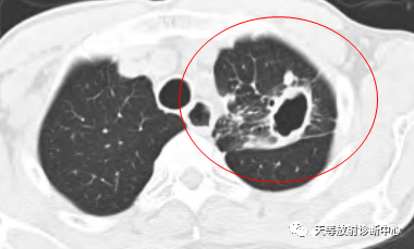 【病例】肺非结核分枝杆菌(NTM-PD)一例CT影像-6 【病例】肺非结核分枝杆菌(NTM-PD)一例CT影像-6