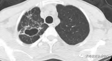 【病例】肺非结核分枝杆菌(NTM-PD)一例CT影像-12 【病例】肺非结核分枝杆菌(NTM-PD)一例CT影像-12