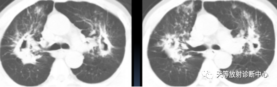 【病例】肺非结核分枝杆菌(NTM-PD)一例CT影像-8 【病例】肺非结核分枝杆菌(NTM-PD)一例CT影像-8