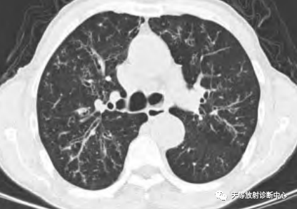 【病例】肺非结核分枝杆菌(NTM-PD)一例CT影像-11 【病例】肺非结核分枝杆菌(NTM-PD)一例CT影像-11