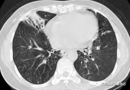 【病例】肺非结核分枝杆菌(NTM-PD)一例CT影像-9 【病例】肺非结核分枝杆菌(NTM-PD)一例CT影像-9