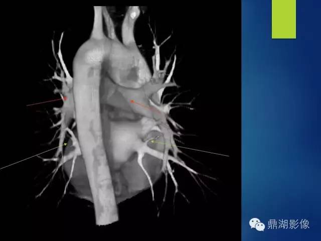 【病例】你真的了解肺门吗？