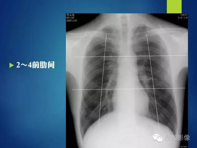 【病例】你真的了解肺门吗？