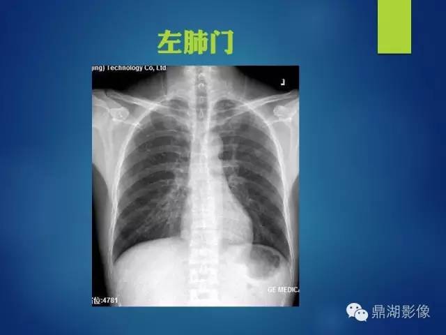 【病例】你真的了解肺门吗？