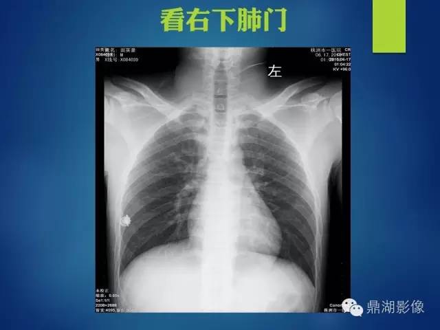 【病例】你真的了解肺门吗？