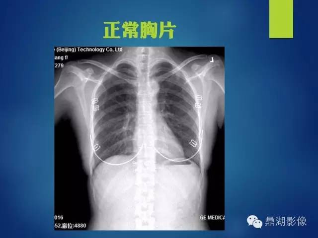 【病例】你真的了解肺门吗？