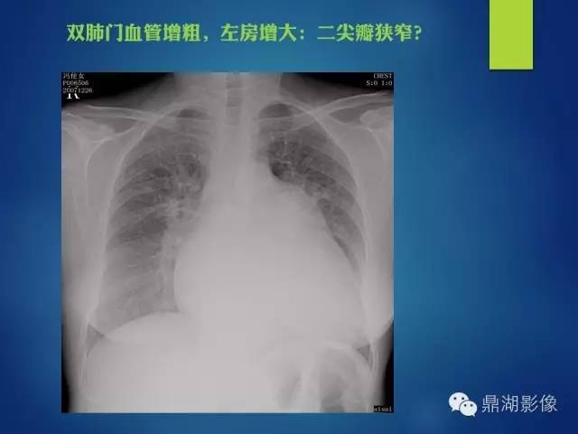 【病例】你真的了解肺门吗？