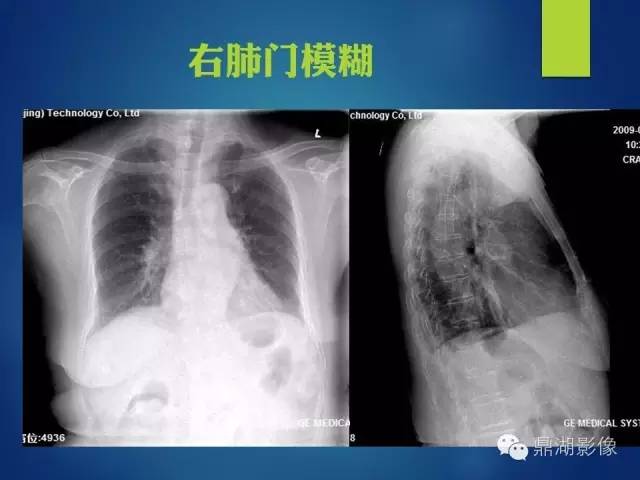 【病例】你真的了解肺门吗？