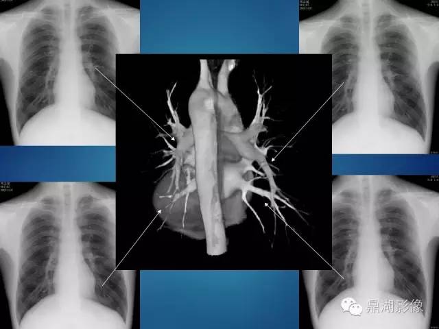 【病例】你真的了解肺门吗？