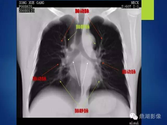 【病例】你真的了解肺门吗？