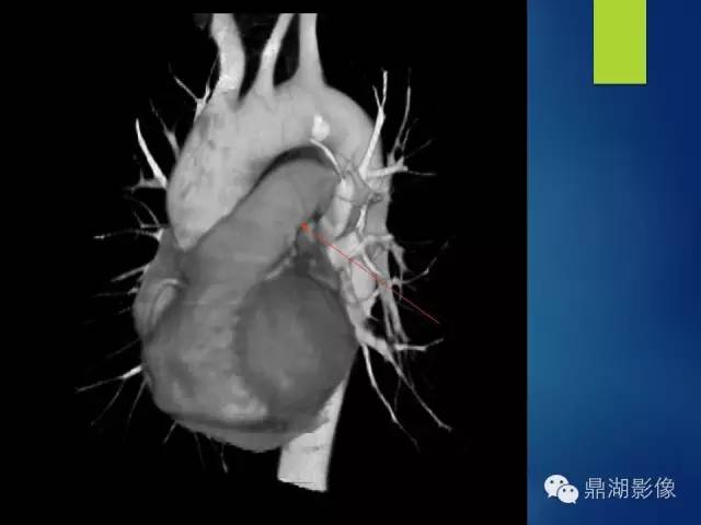 【病例】你真的了解肺门吗？