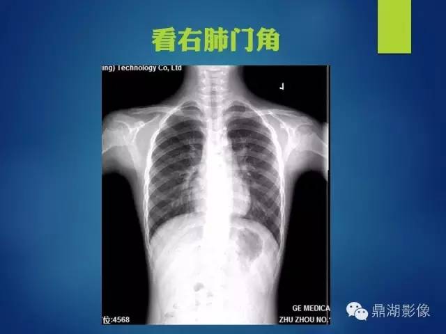 【病例】你真的了解肺门吗？