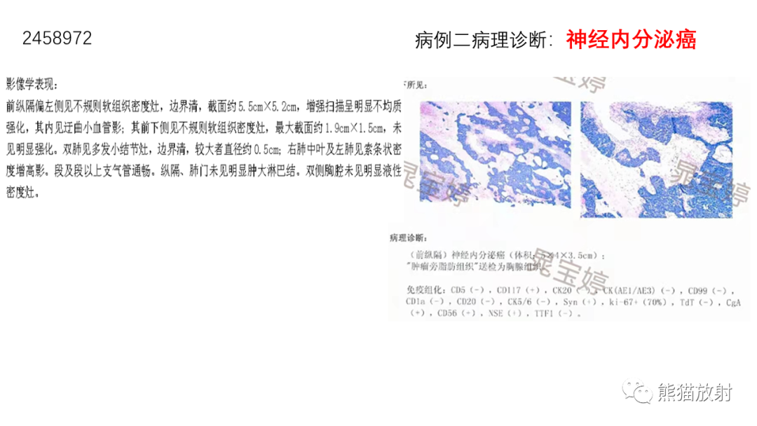 【病例】胸腺神经内分泌肿瘤2例CT影像-15