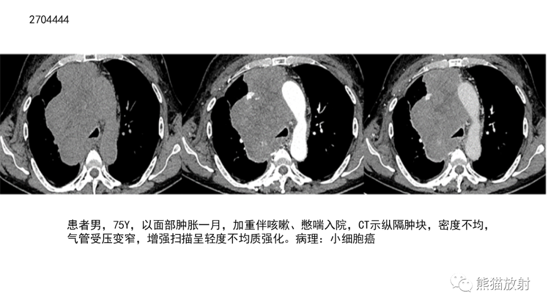 【病例】胸腺神经内分泌肿瘤2例CT影像-24