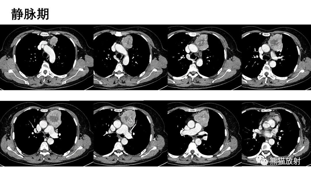 【病例】胸腺神经内分泌肿瘤2例CT影像-12