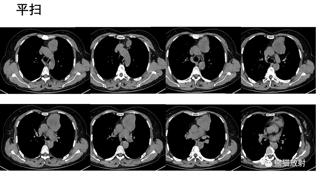 【病例】胸腺神经内分泌肿瘤2例CT影像-11