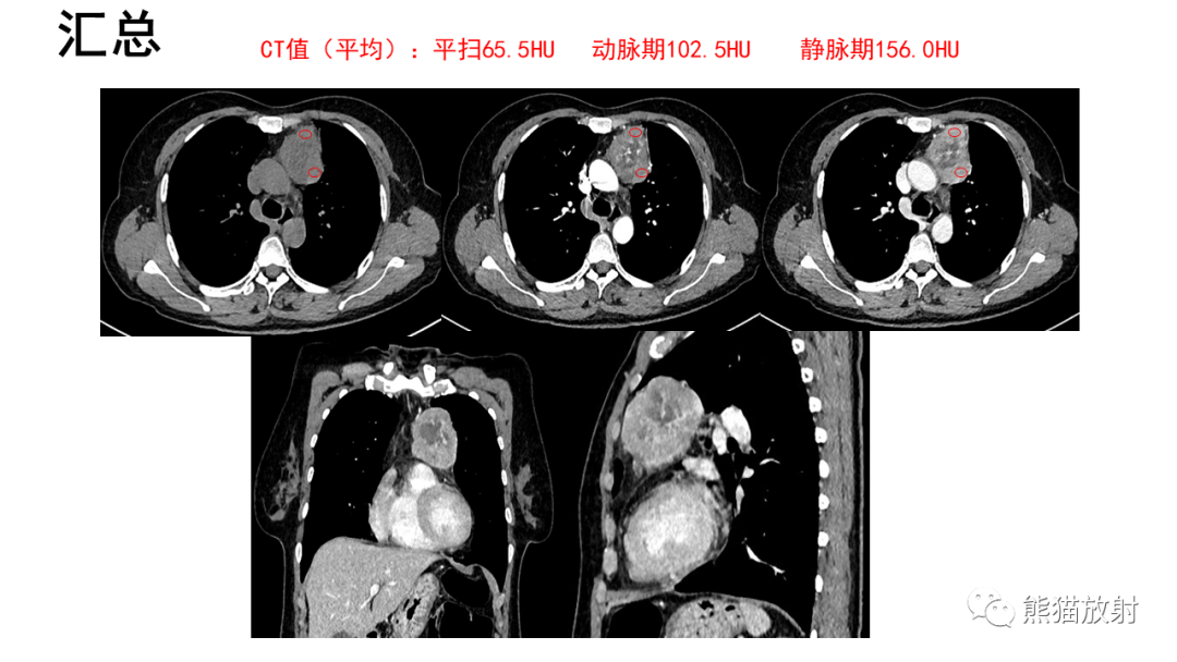 【病例】胸腺神经内分泌肿瘤2例CT影像-10