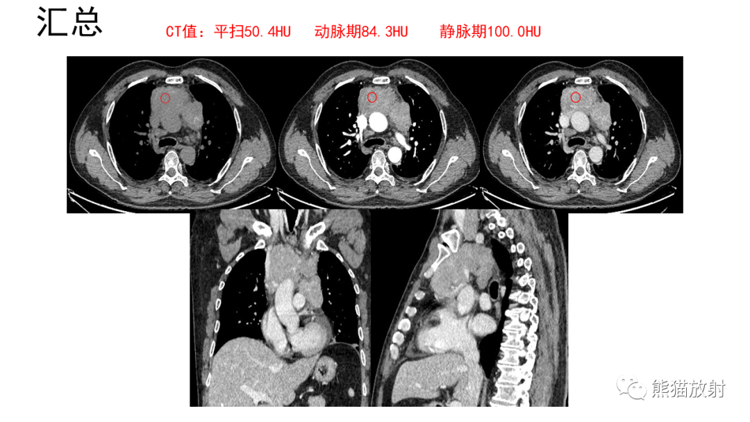 【病例】胸腺神经内分泌肿瘤2例CT影像-4