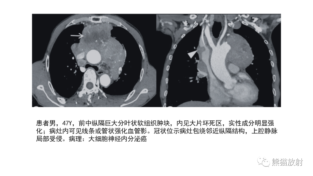 【病例】胸腺神经内分泌肿瘤2例CT影像-25