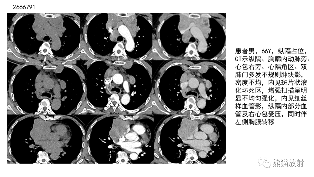 【病例】胸腺神经内分泌肿瘤2例CT影像-23