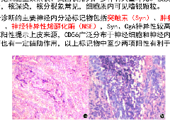 胸腺神经内分泌肿瘤2例CT影像