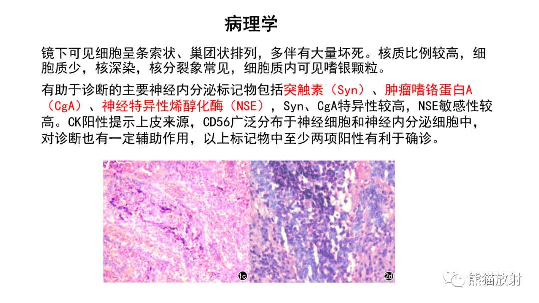 【病例】胸腺神经内分泌肿瘤2例CT影像-21