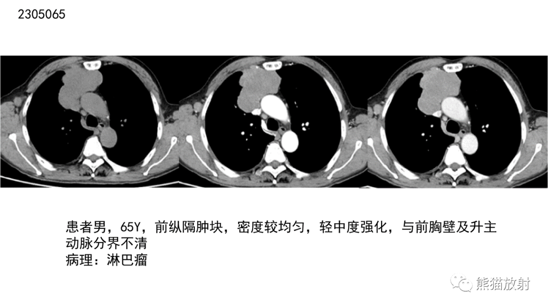 【病例】胸腺神经内分泌肿瘤2例CT影像-39