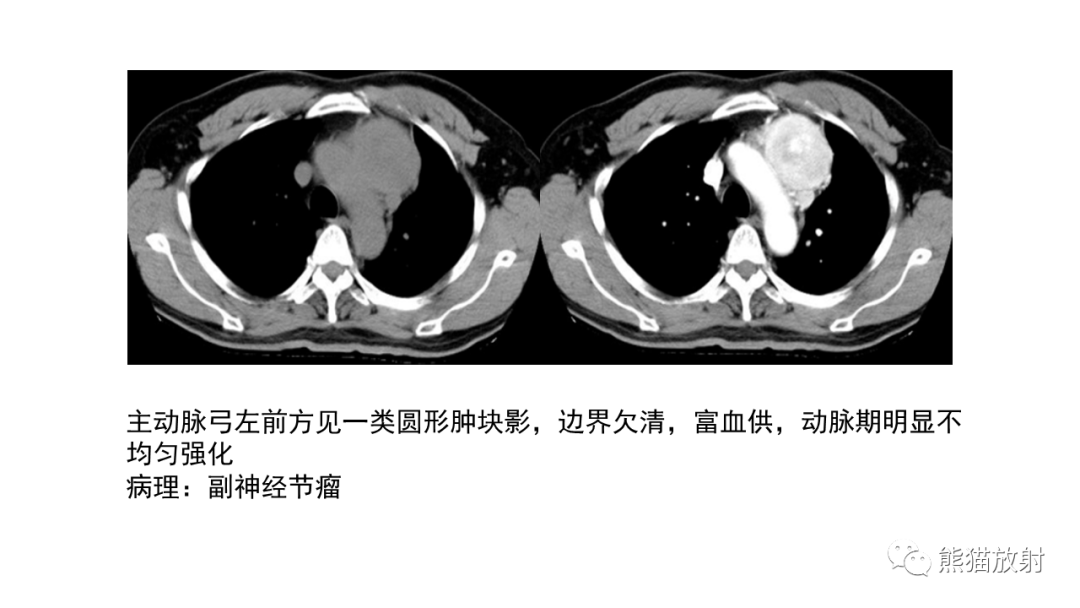 【病例】胸腺神经内分泌肿瘤2例CT影像-41