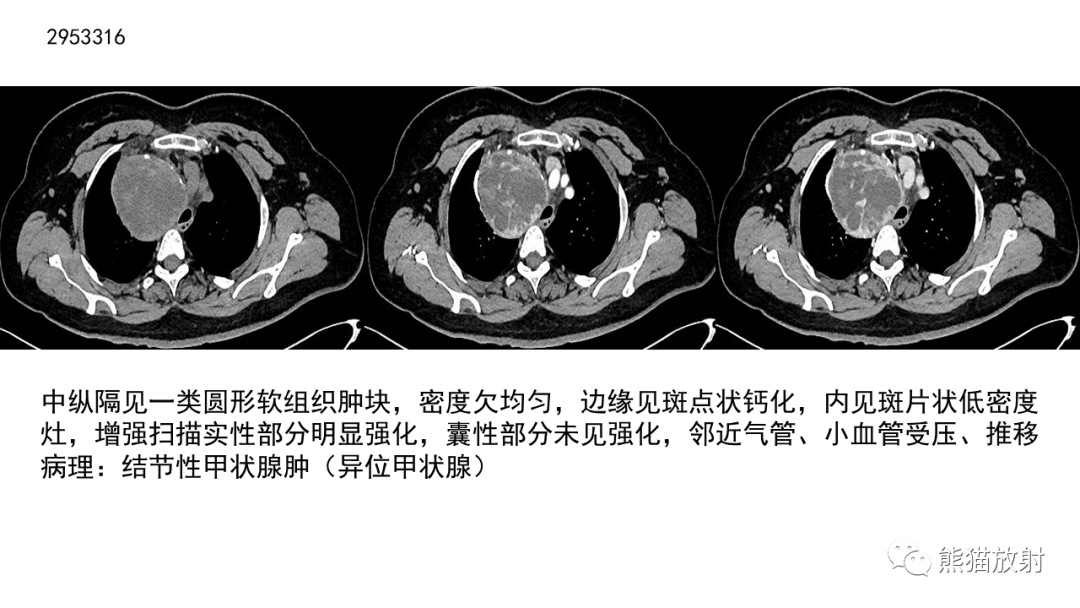 【病例】胸腺神经内分泌肿瘤2例CT影像-33