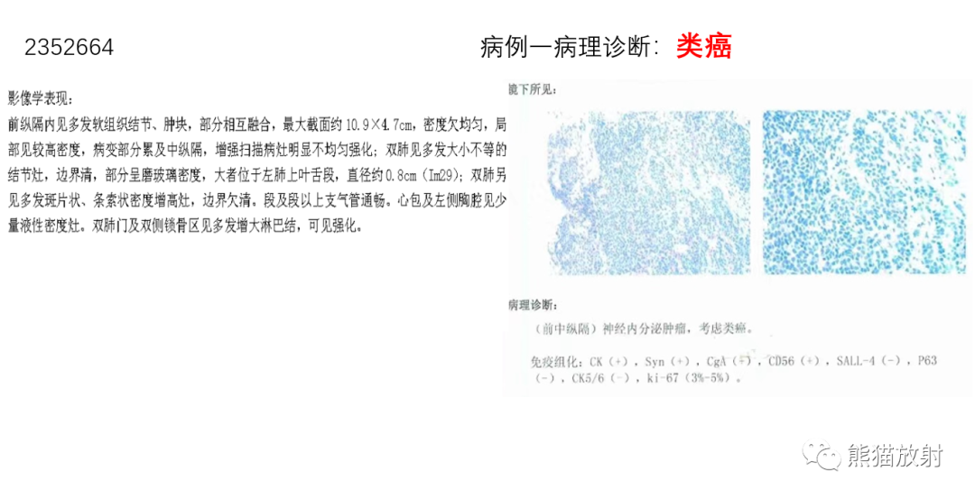 【病例】胸腺神经内分泌肿瘤2例CT影像-14